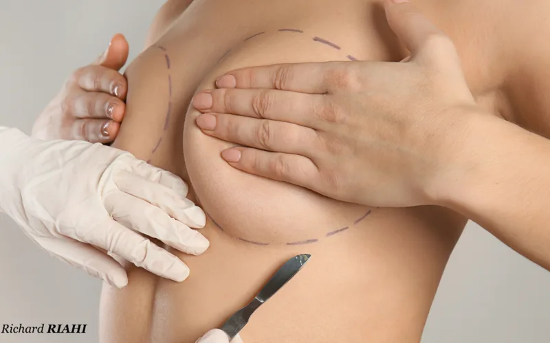 Augmentation mammaire et ptôse mammaire