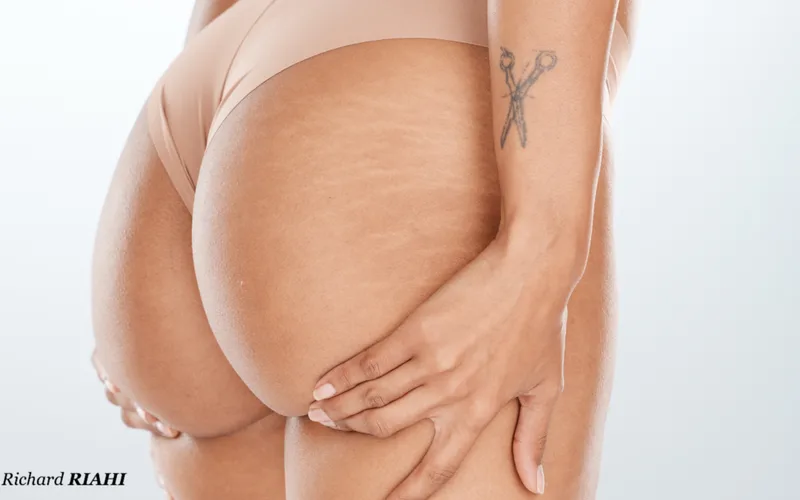 Implants fessiers