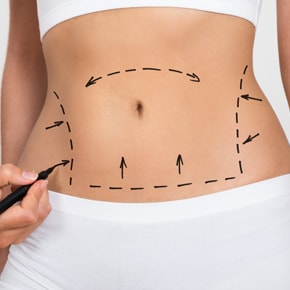 Abdominoplastie
