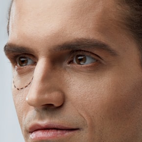 Blépharoplastie
