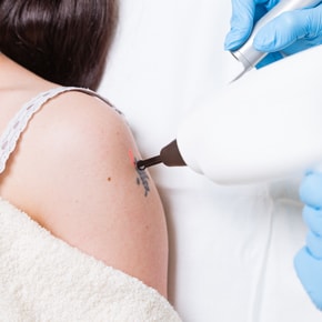 Détatouage laser